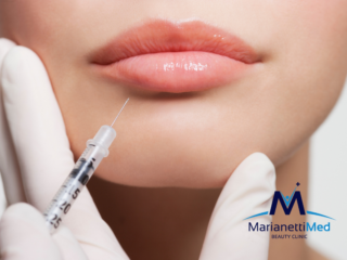 filler labbra Avezzano 