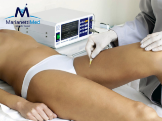 Carbossiterapia Cellulite Avezzano