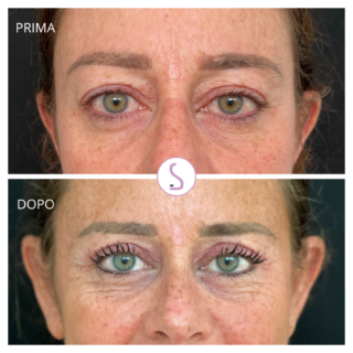 Blefaroplastica Avezzano