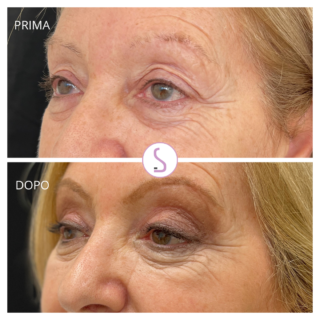 Blefaroplastica superiore Avezzano