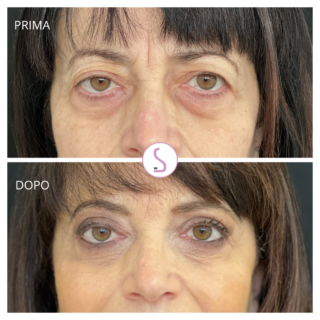 blefaroplastica superiore Avezzano